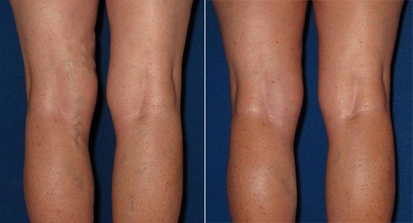 Как избавиться от варикоза за две недели   