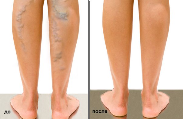 Девочки, поделюсь с вами моей РЕАЛЬНОЙ историей избавления от варикоза. Сколько слез я пролила, сколько денег потратила на разное лечение вам не передать! Понимала я, какая тяжела болезнь этот ваш варикоз, потому что мама моя и бабка тоже всю жизнь им мучались. 