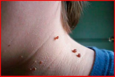 УМОЛЯЮ, не надо удалять ПАПИЛЛОМЫ!