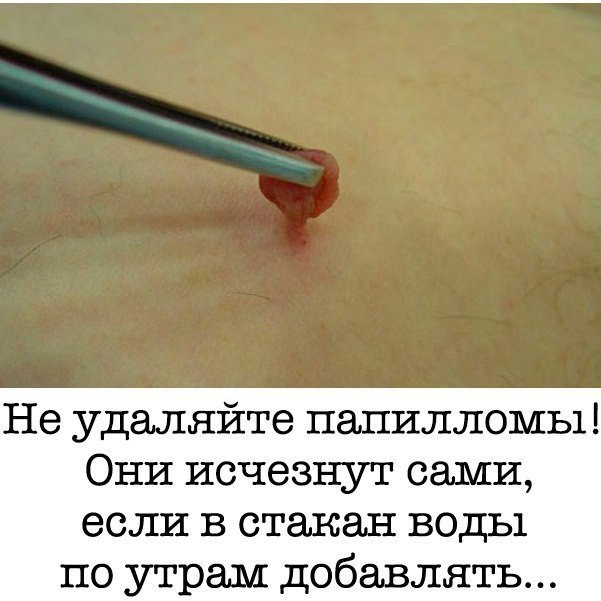 Не удаляйте папилломы! Они исчезнут сами, если в стакан воды по утрам добавлять... 